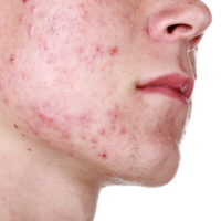 bigstock-Severe-Acne-24802256