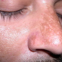 melasma15