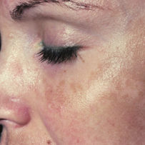 phototake_rm_melasma_face_woman