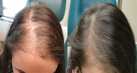 Hair Transplant Results