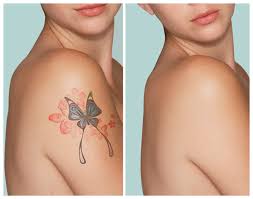 Laser for Tattoo Removal in Himachal
