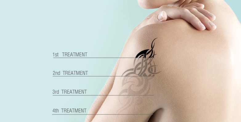 Tattoo Removal Treatment in Himachal | Skin Speacilist in Himachal