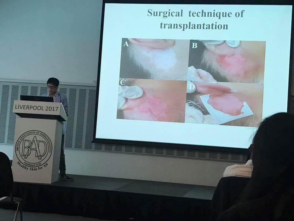 Work Presentation on Vitiligo Surgery at Liverpool, London-Best Dermatologist in India 