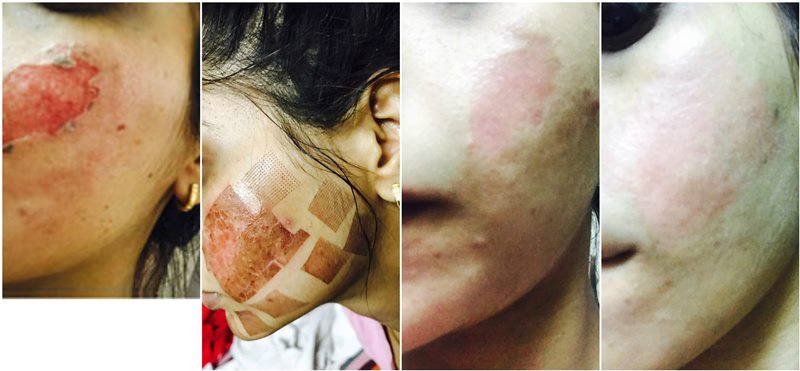 Burn scar Treatment at Neelkanth Hospital