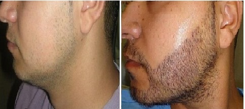 Beard Implantation Results