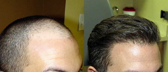 Best and Affordable Hair Transplant in Himachal | Best Hospital in Mandi