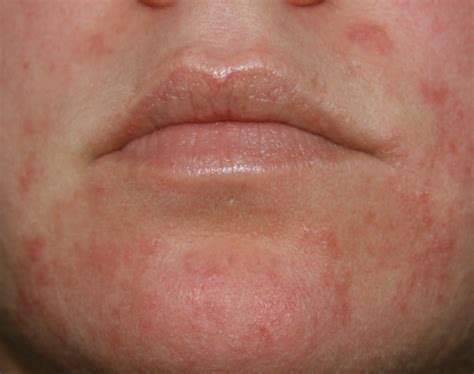Urticaria (Hives) and Angioedema (Swelling)