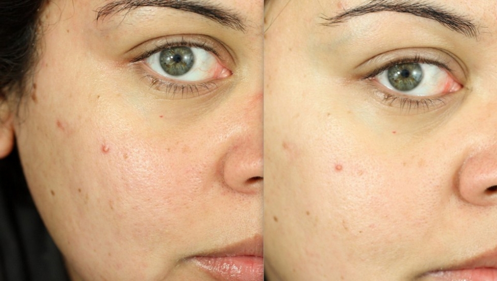 Acne Treatment with Chemical Peel