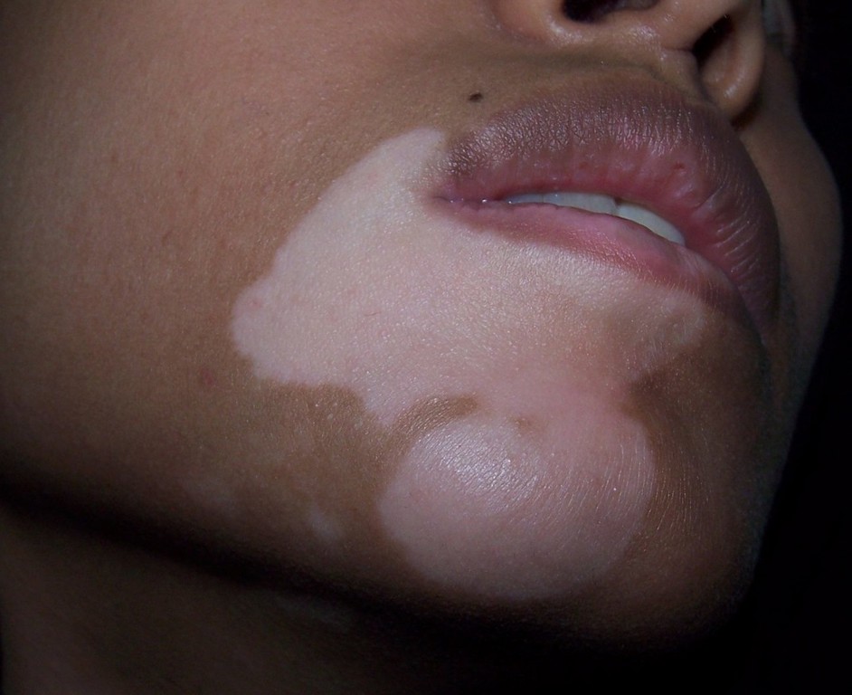 Non-Segmental Vitiligo