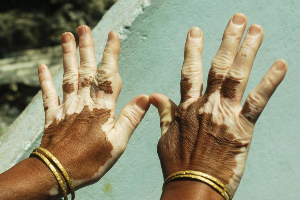 Vitiligo is a skin condition in which patches of skin lose their color.