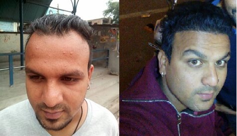 Hair Transplant in Himachal Pradesh | Dr. Sahil Mrigpuri