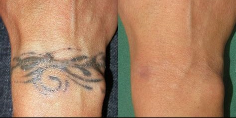 Laser Tattoo Removal in Himachal Pradesh