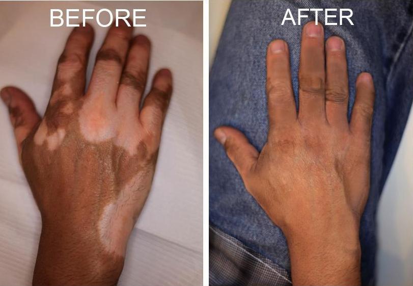 Vitiligo Treatment Results 