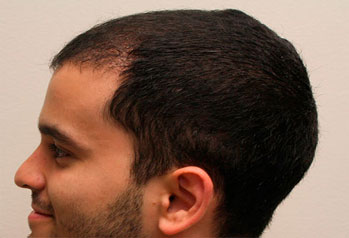 After-Hair Transplant