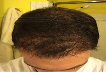 After-Hair Transplant