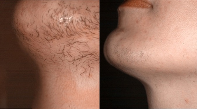 Laser Hair Removal in Himachal | Dr Sahil Mrigpuri (  Dermatology)