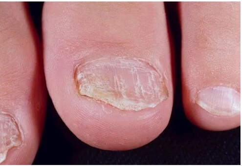 Psoriasis of the Nails