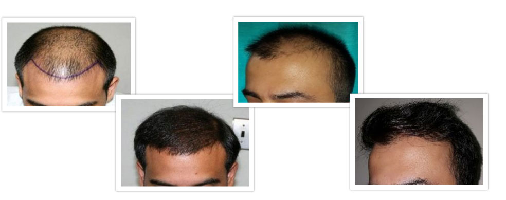 Results of Natural Hair Transplant in Himachal