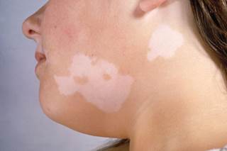 Vitiligo Treatment in Himachal Pradesh