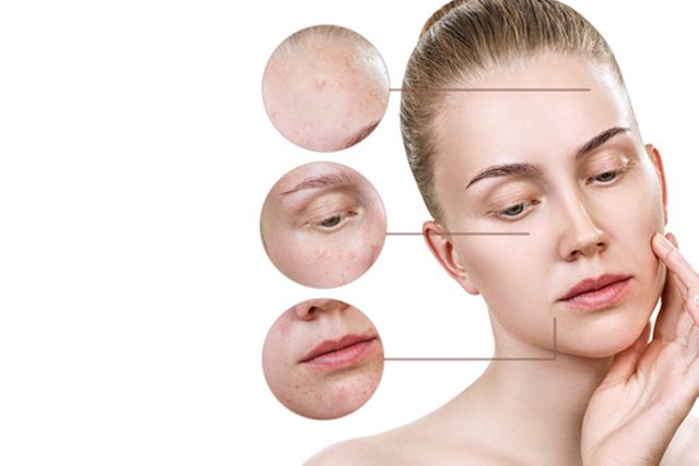 Laser for Melasma, Freckles, and Pigmentation