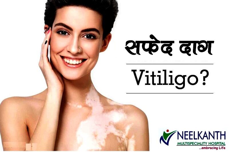 Best Vitiligo and Leucoderma Treatment in Himachal