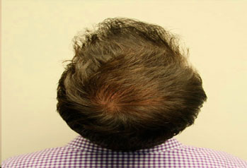 After-FUE Hair Transplant
