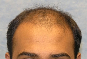 Before-Hair Transplant
