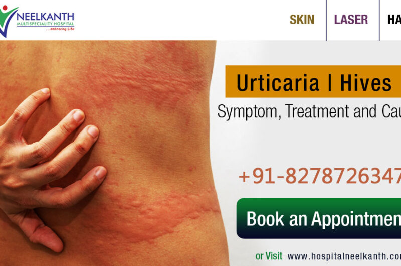 Urticaria | Hives – Symptom, Treatment and Causes