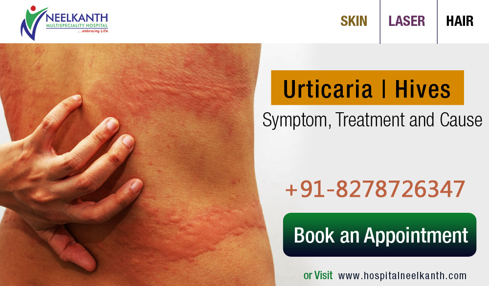 Urticaria | Hives – Symptom, Treatment and Causes