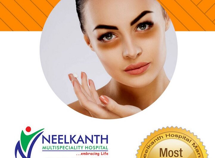 Dark Circles (Periorbital Pigmentation) – Causes, Treatment & Prevention