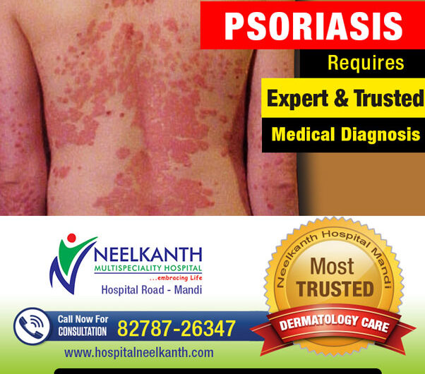 Psoriasis – Symptom, Treatment and Causes
