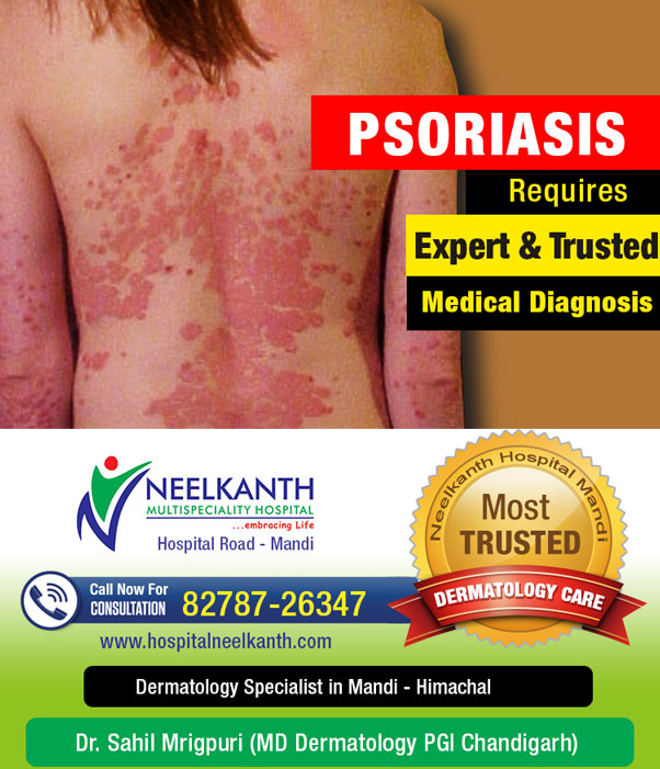 Psoriasis - Symptom, Treatment and Causes - Hair & Skin Hospital in ...